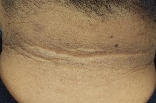 腸漏，發炎的關鍵》這裡太黑，小心「黑色棘皮症」上身！